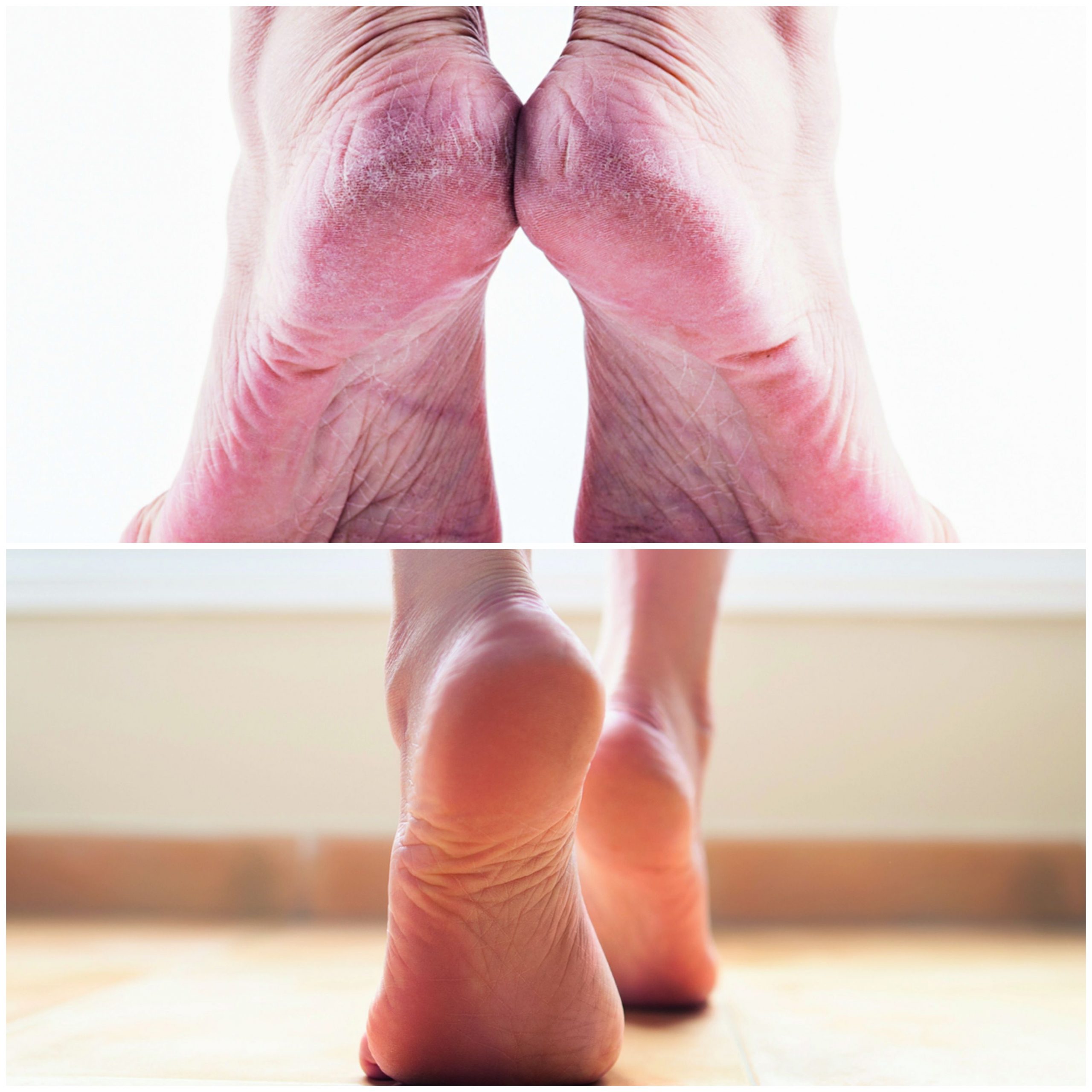 Diabetes Fuß-Pflege in drei Schritten - Herzwiese